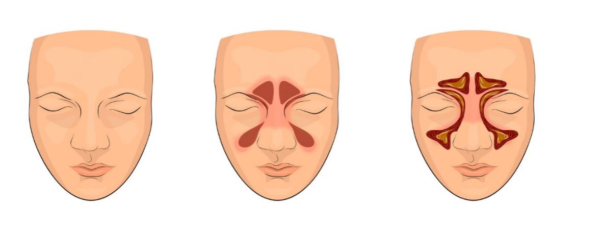 rinozine - alergiczny nieżyt nosa5